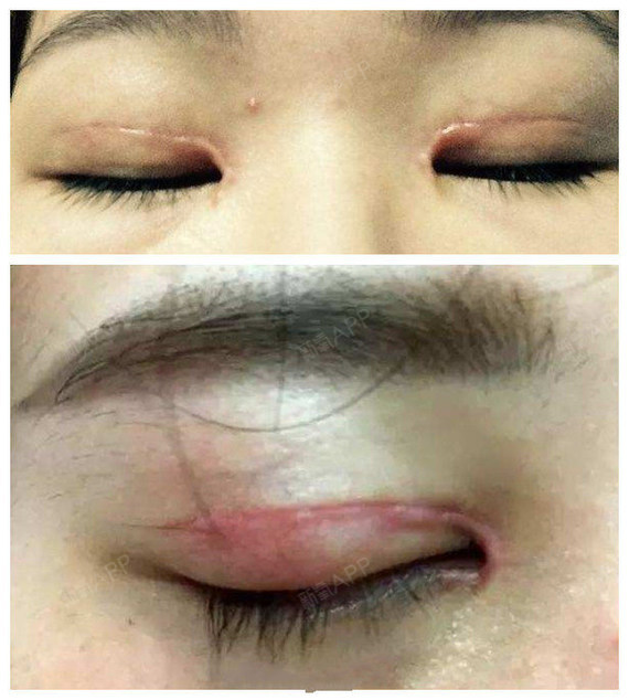 双眼皮术后出现疤痕增生怎么办?