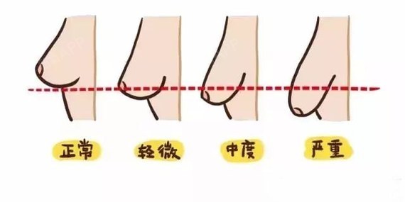 韩国da整形医院【怎么预防乳房下垂】