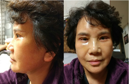 手术项目:黄金拉皮术,埋线双眼皮,下眼睑整形