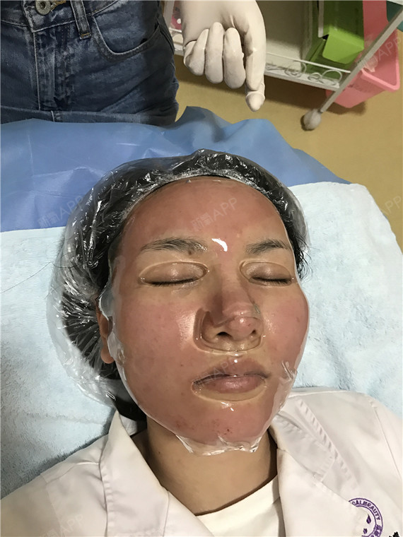 广州微针美塑好不好_效果图_氧气_lrob692微针美塑术后第0天_新氧美容