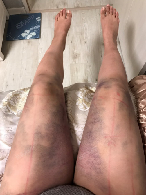 关于大腿吸脂后鸡皮肤发痒怎么回事的信息