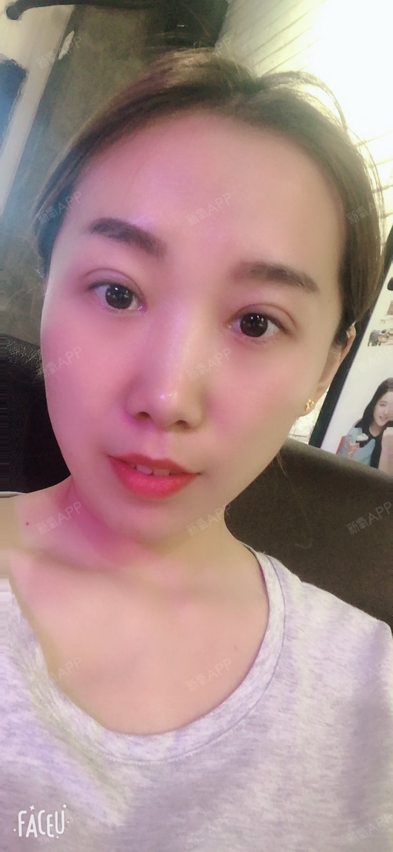 慵懒的花小猫切开双眼皮第20天美丽日记