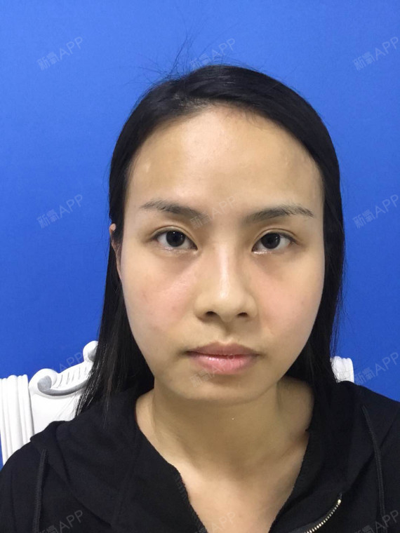 我的脸不对称,左边咬肌很大,右边肉多,整张脸胖的有_圈子-新氧美容