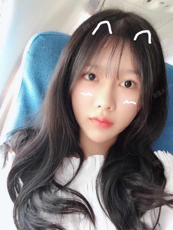 注射瘦脸好不好_效果图_capricorn笑笑注射瘦脸术后第28天_新氧美容