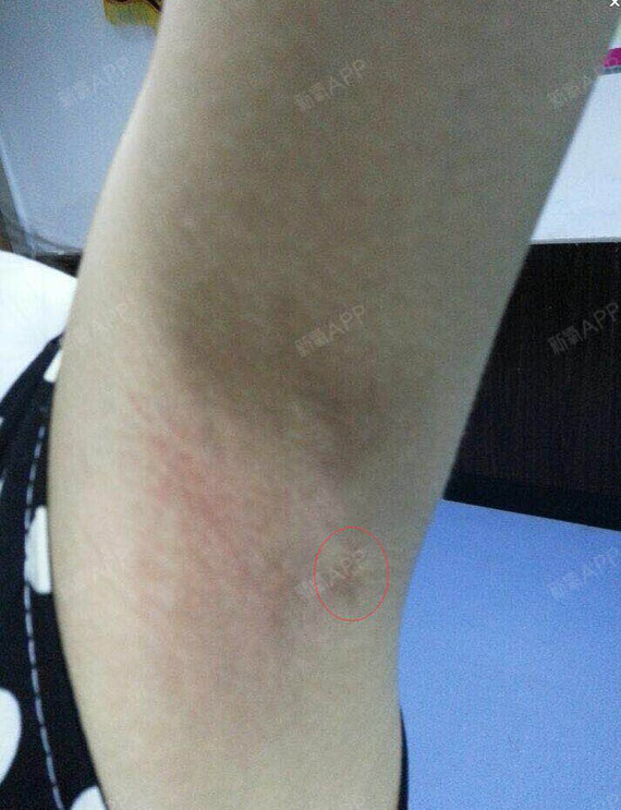 北京注射治疗多汗好不好_效果图_ˊmeteor宇注射治疗