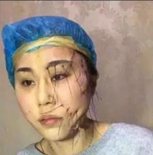 面部线雕后有后悔的吗,线雕副作用后遗症吓人!