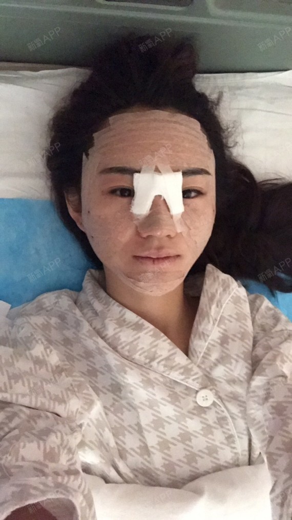 新氧- 里睿可 | 眼部 | 开眼角 | 开内眼角 | 术后当自强 | 北京同城