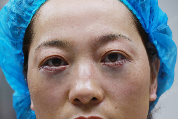 外切去眼袋好不好_效果图_一树荼蘼久爱不腻外切去眼袋术后第1天_新氧