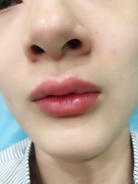 化蝶 玻尿酸注射嘟嘟唇】上次打下巴感觉还可以_圈子-新氧美容整形