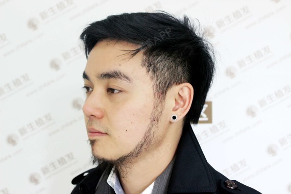 现在胡子和双鬓处的毛发应该是没有大问题了,长得都非常好.