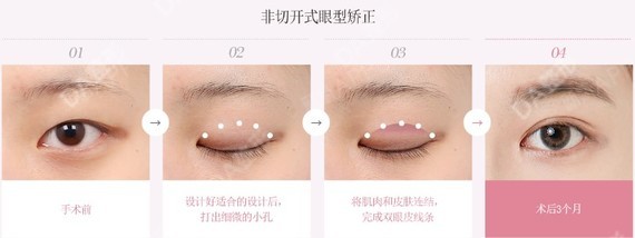 韩国da整形医院眼型矫正术