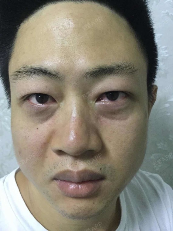今天就过来做去眼袋手术,老婆怕我一个大男人来医美医院不好意思,陪着