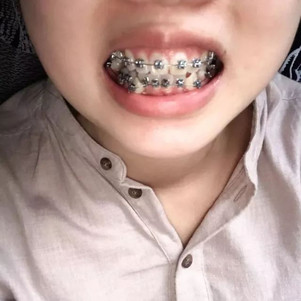 门牙缝隙 凸嘴矫正-新氧美容整形