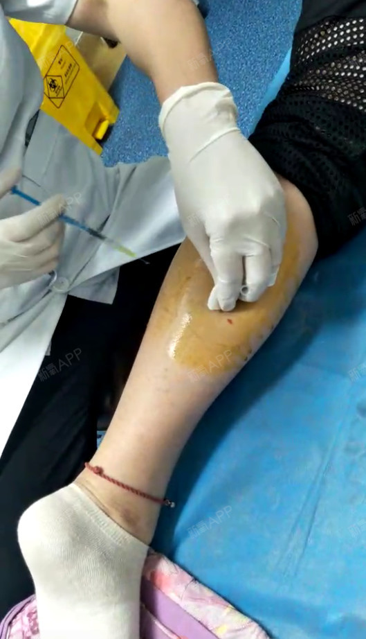 注射瘦小腿好不好_效果图_也许乂没有也许注射瘦小腿术后第0天_新氧