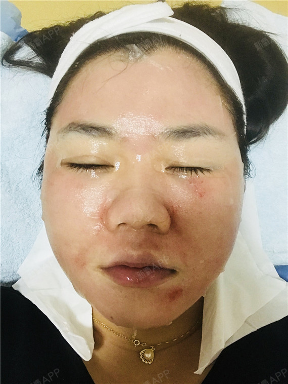 广州伊肤泉微针好不好_效果图_敢不敢睁开眼睛伊肤泉微针术后第天