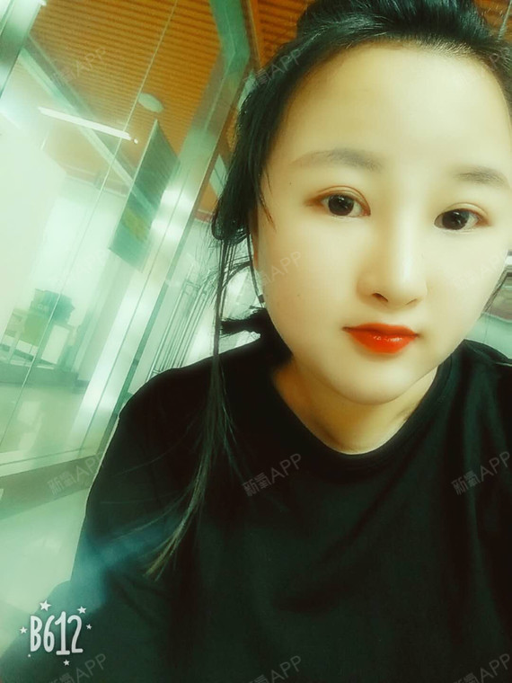 世态炎凉冷暖自知9玻尿酸隆鼻第128天美丽日