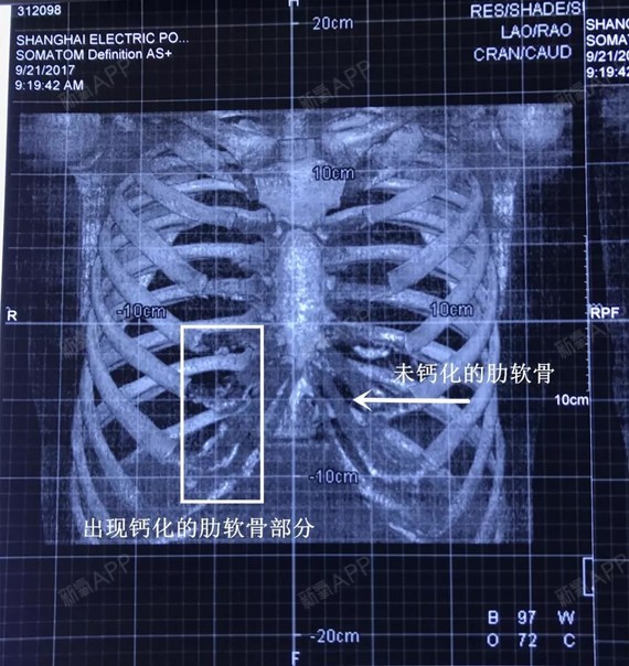 穿刺判断法容易出错,所以 更推荐术前照x光或ct肋骨三维重建诊断