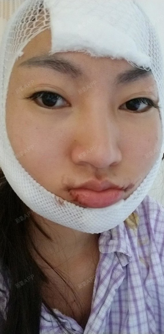 最近几年一直打的瘦脸针,效果不是很理想,就想通过手术彻底改变下颌