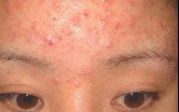 "痘痘""螨虫"傻傻分不清,别再被这3个症状给"骗"了!