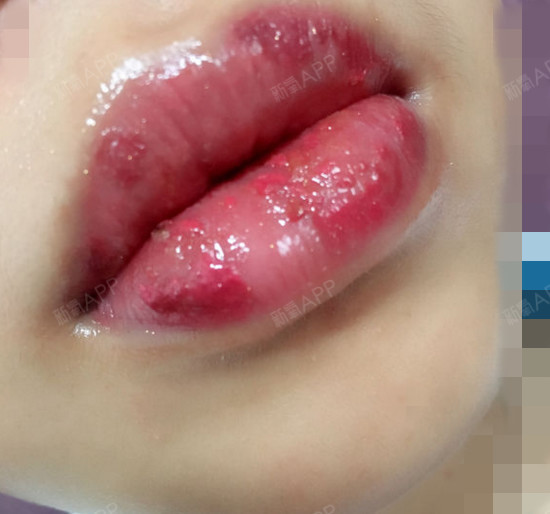 纹唇脱痂图片过程图片