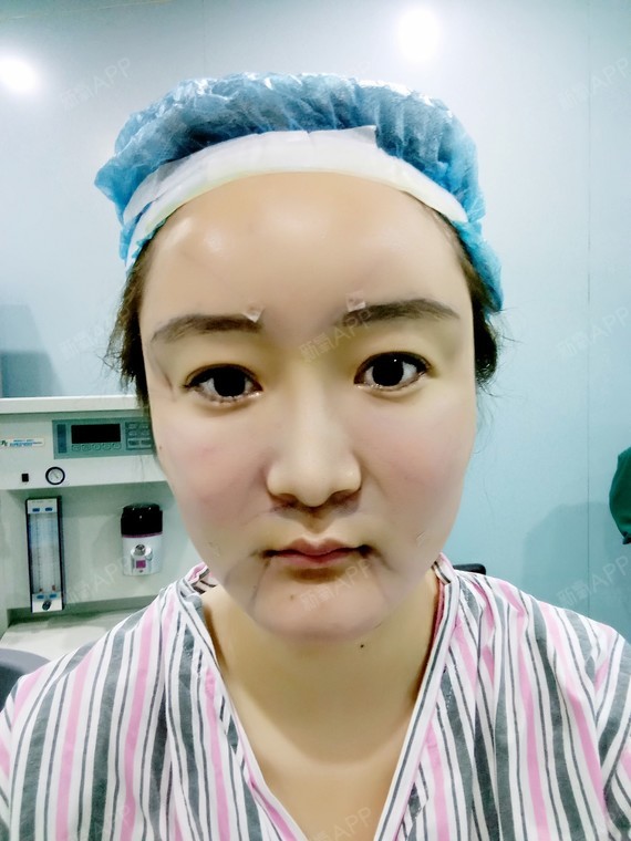 氧气x2ayi自体脂肪全脸填充第0天美丽日记