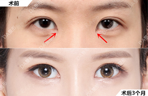 2.两眼间距较宽的人群