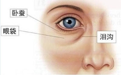 请问用玻尿酸填充泪沟后 反而形成两层 新氧美容整形