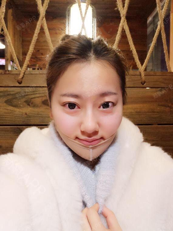 面部吸脂好不好_效果图_哒沫沫面部吸脂术后第18天_新氧美容整形