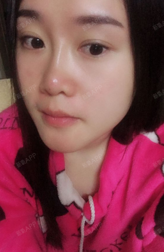 刚打了玻尿酸,打的鼻子,还没消肿,有一点涨涨的感觉_圈子-新氧美容