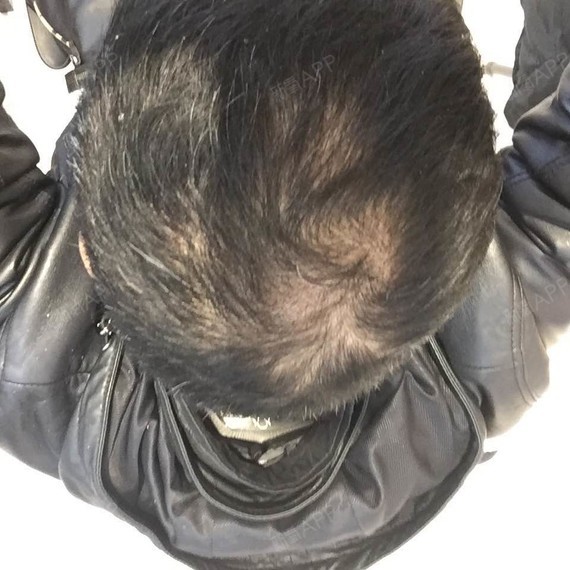 术后115天好久没来更新,头发加密差不多四个月了!_圈子-新氧美容整形