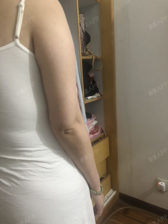 长沙吸脂瘦臀部好不好_效果图_氧气_466918吸脂瘦臀部术后第42天_新氧