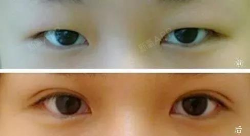 直击肿泡眼全切双眼皮的手术现场,带你看看全过程!