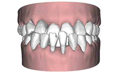 地包天早发现早治疗