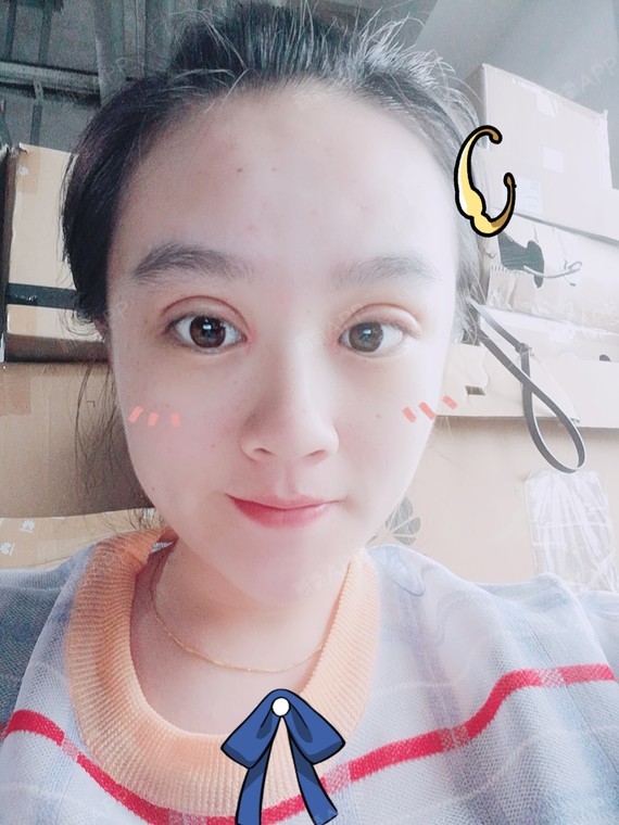 切开双眼皮好不好_效果图_pimok切开双眼皮术后第14天_新氧美容整形