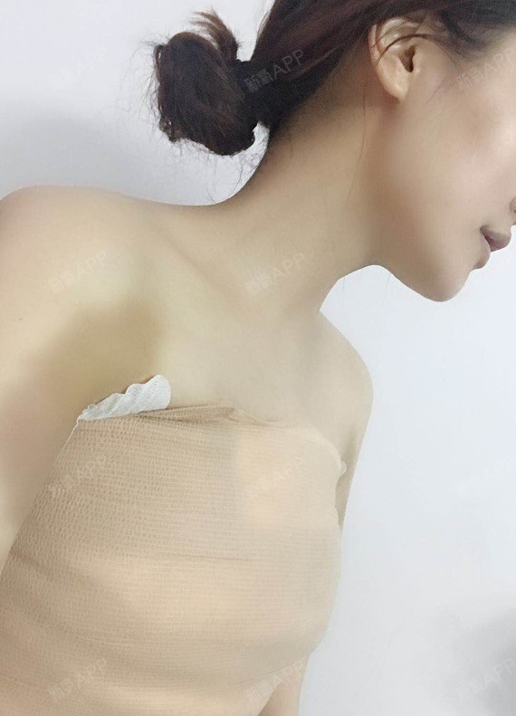 在家的呢 【曼托假体隆胸手术第三天】 不会痛 活动自如