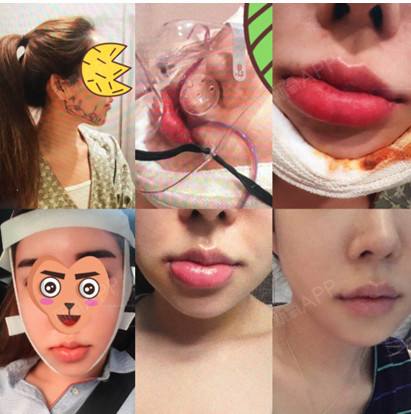 【博朗温整形外科】金兑奎院长面部轮廓 v脸手术真实后记!