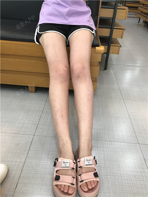 武汉吸脂瘦大腿好不好_效果图_无爱之城吸脂瘦大腿术后第50天_新氧