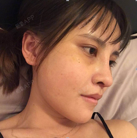 鼻综合