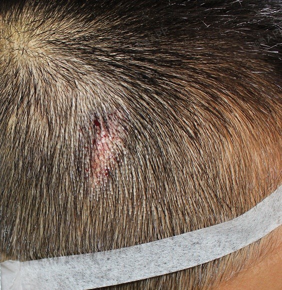 疤痕种植好不好_效果图_氧气x0e15疤痕种植术后第0天_新氧美容整形