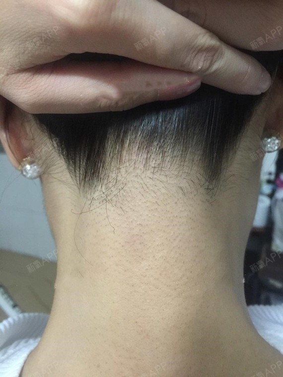 脱发际线好不好_效果图_等风来11585脱发际线术后第44天_新氧美容整形