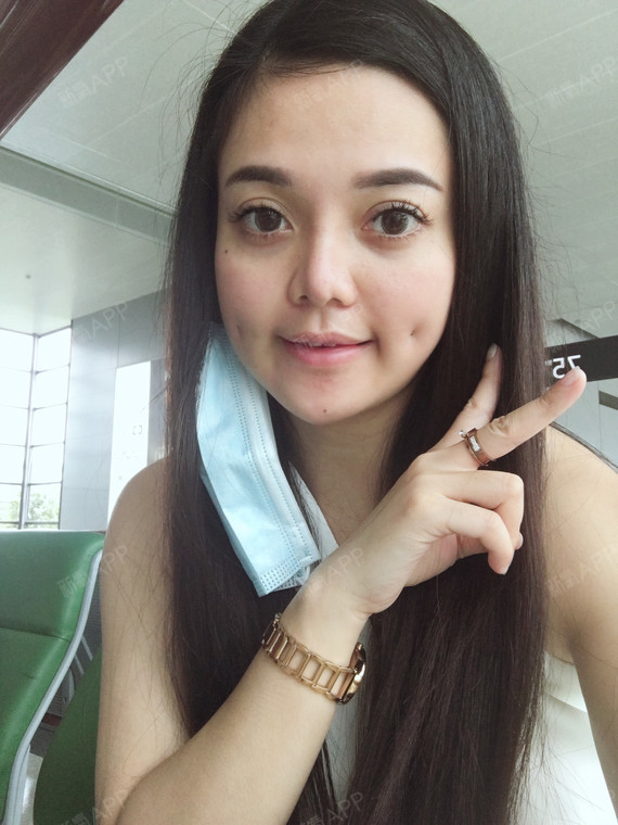 酒窝少女101酒窝成形术术后第3天美丽日记_新氧整形