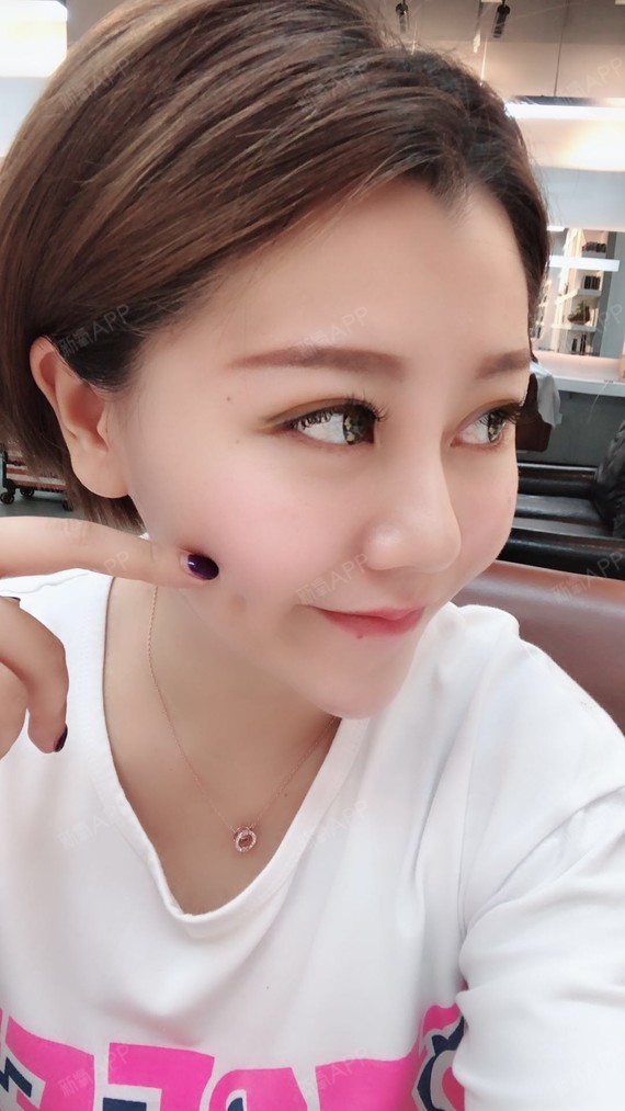 好看无罪酒窝成形术第75天美丽日记-新氧美容整形