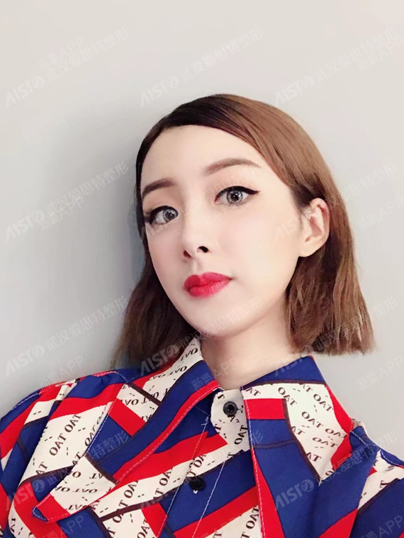 眼综合 鼻综合.术后72天】小眼聚神_圈子-新氧美容整形