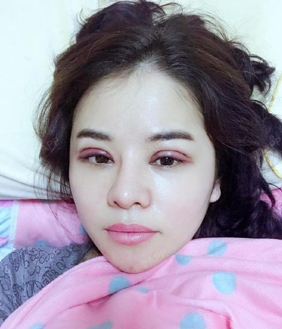 做完手术第1天,肿肿的,医生说做完双眼皮手术一周内眼睛是不