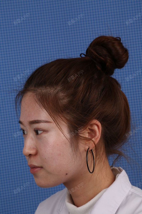 我朋友说我的鼻子趴趴着的而且鼻翼看上去有点大,如果_圈子-新氧美容