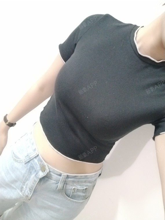 北京腹壁成形术好不好_效果图_十二a腹壁成形术术后第137天_新氧美容
