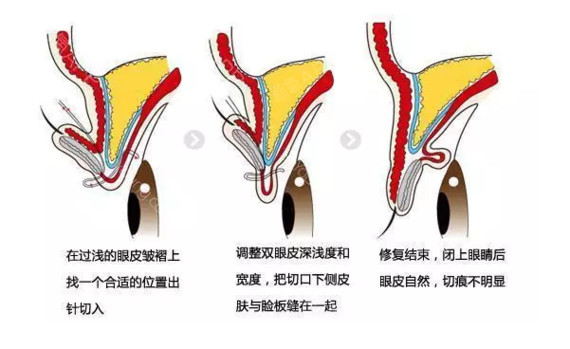 关于双眼皮修复,你必须了解这些