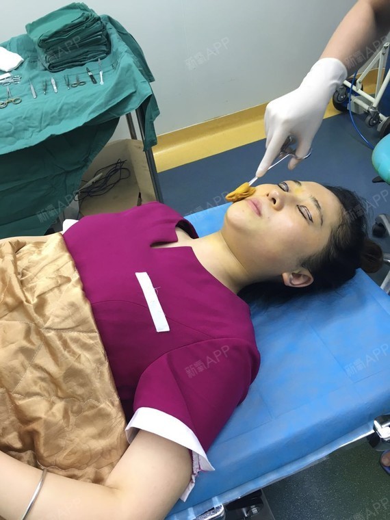 [术后当天即刻]今天刚刚在素美做了双眼皮_圈子-新氧美容整形
