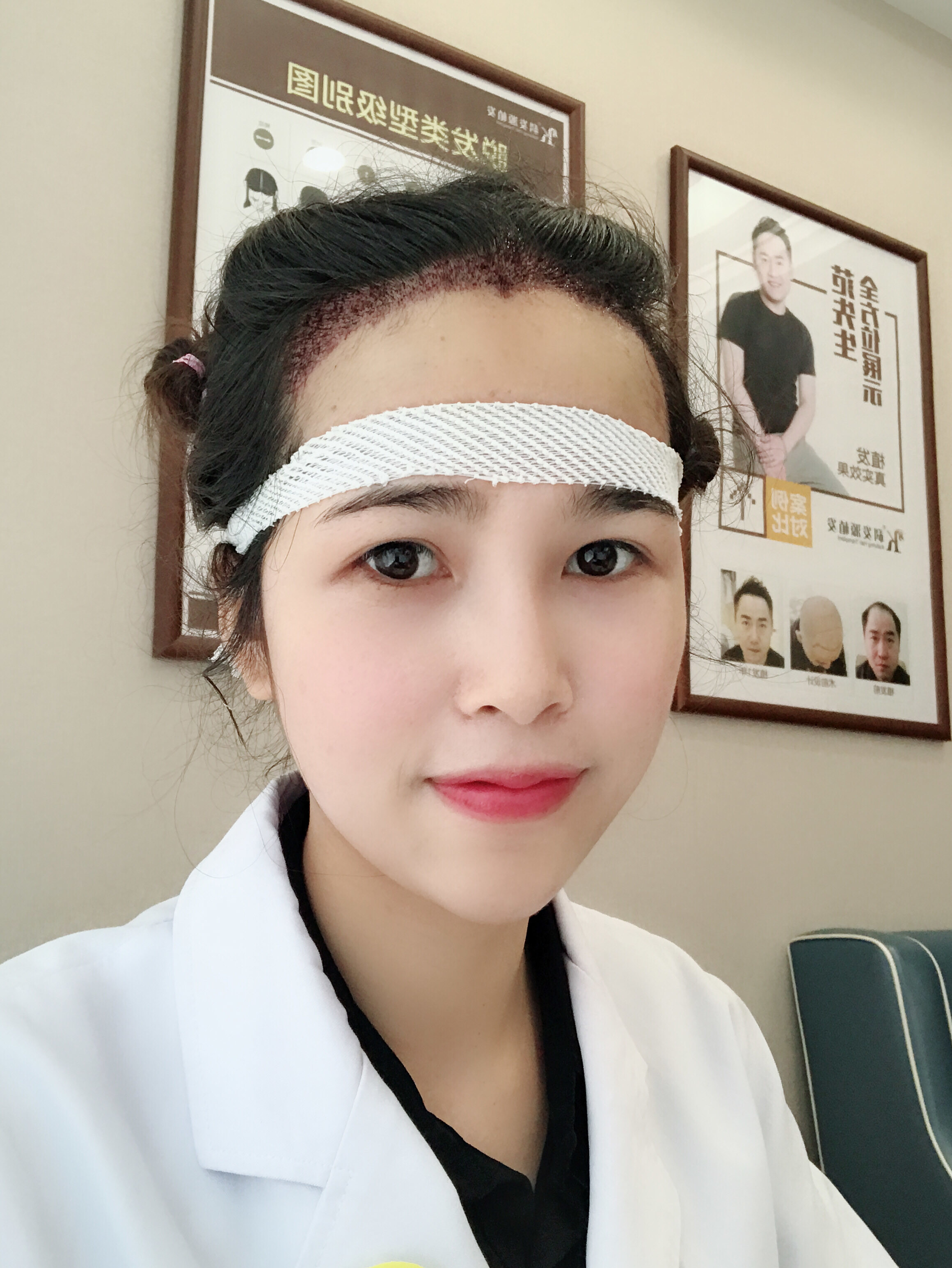 99亲自体验微针植发技术,用通俗的话说就是:"种植孔_圈子-新氧美容