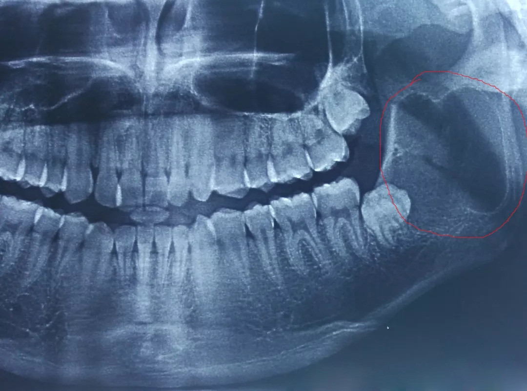 智齒,又叫第三磨牙,是生長在牙列最末端的牙齒,很多人叫它
